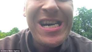 I'M The Real Life Jaws': Student, 36, Has Condition Which Means His Jaw  Bone Won'T Stop Growing | Daily Mail Online