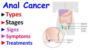 If you have any of these signs, see your doctor. Anal Cancer Intro Types Stages Signs Symptoms And Treatment Options Youtube
