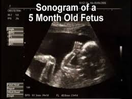 No14 days = 2 weeks17 days is 3 days more. Pregnancy Weeks 17 20 Month 5 Youtube