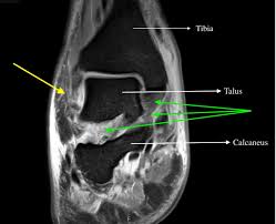 Image result for Septic Joint