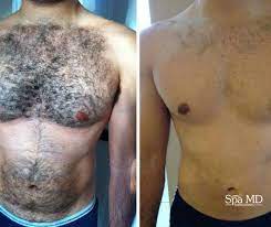 Laser hair removal is the easiest way for men to eliminate unwanted body hair. Laser Hair Removal Is For Both Men And Women Laser Hair Removal Men Laser Hair Removal Face Hair Removal Cream