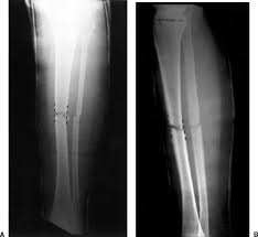 We did not find results for: Tibial And Fibular Shafts Radiology Key