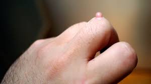 Common warts are small, grainy skin growths that occur most often on your fingers or hands. Warts Types Home Treatment And Prevention