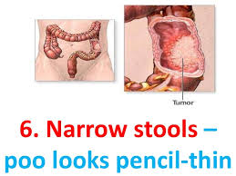 2 if you have risk factors, like a family history of colon cancer, you should discuss any symptoms with your doctor. Symptoms Of Colon Colorectal Cancer In Men Women
