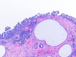 An endometrial polyp or uterine polyp is a mass in the inner lining of the uterus. Pathology Outlines Serous Carcinoma