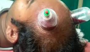 Hair usually grows back within about 2 to 6 months. Hijama Therapy For Hair Loss Treatment In Dwarka Delhi