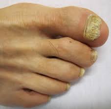 Image result for Onycholysis feet