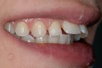 Vorstehende Zahne Dr Grimmel Ihr Spezialist In Dubendorf