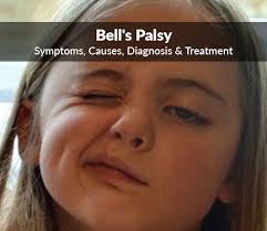 Bell's palsy is a sudden weakness or paralysis in one side of the face. Idiopathic Facial Paralysis Bell S Palsy Symptoms Causes Diagnosis Treatment