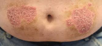 Image result for koebner phenomenon psoriasis
