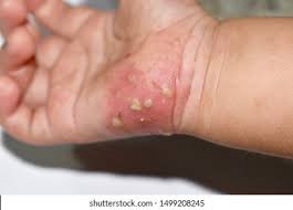 Image result for scabies human children