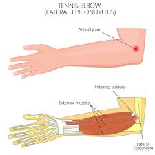 Sometimes referred to as student's elbow or miner's. Tennis Elbow Lateral Epicondylitis Elbow Specialists Boise Meridian Nampa Treasure Valley