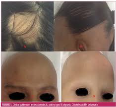 Puva treatment of alopecia areatapartialis, totalis and universalis: The Role Of Dermoscopy In Severity Assessment Of Alopecia Areata A Tertiary Care Center Study Jcad The Journal Of Clinical And Aesthetic Dermatology