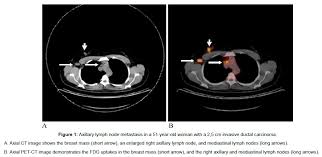 Path lab reports are like a secret code! Can Fdg Pet Ct And Ct Exclude N2 And N3 Nodal Disease In Patients With Breast Cancer Scitechnol