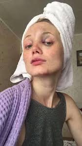 Kira Dice Shared Pics of Her Face After Alleged Assault by Boyfriend