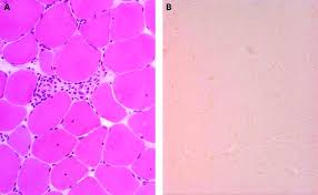 Image result for Polymyositis