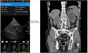 Ct Scan Of Kidney Stones Ct Scan Machine