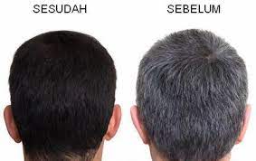Perawatan rambut beruban merawat kelembaban dan minyak di kulit kepala dapat mengurangi rambut kusam dan kering. Rawatan Rambut Beruban Gugur Dan Kelimumur Home Facebook