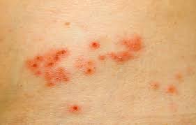 Is Shingles Sexually Transmitted Causes Symptoms Of Shingles Harley Street Gynaecology