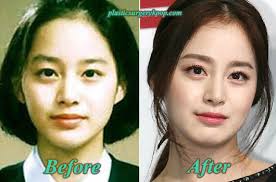 The desire for a thin nose with narrow nostrils has been driving many celebrities to go for a nose job. Lee Da Hae Plastic Surgery Before And After