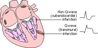 Image result for Q Wave