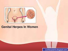 Below is a collection of herpes pictures that are in aim of showing you that not all herpes cases are severe and nasty. Genital Herpes In Women