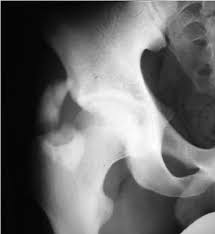 I was doing high jump and twisted my body and in the process my muscle ripped my growth bone off. Ap Radiograph Of The Right Hip Revealed Avulsion Fracture Of Aiis Four Download Scientific Diagram