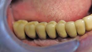 Eine 2002 gegründete tochterfirma in den usa und vertriebspartner in über 100 ländern machen meisinger zu einem global player der medizintechnik. Implantatversorgung Von Rauchern Mit Drs Implantatsystem Implantologie Dimagazin Aktuell De