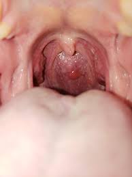 Check spelling or type a new query. Have Had This Bump Back Of Throat For 2 Months Ent Doc Said It S Nothing Same With Pcp What The Heck Cancer Askdoctorsmeeee