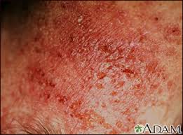 Image result for contact dermatitis