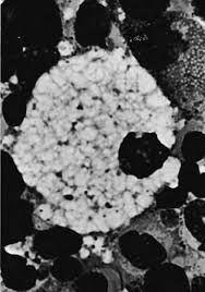 Typical Foam Cell From The Marrow Of A Patient With Niemann Pick Disease Download Scientific Diagram