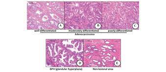 The controversial relationship between benign prostatic hyperplasia and prostate cancer: Immunohistochemical Expression Of Four Different Stem Cell Markers In Prostate Cancer High Expression Of Nanog In Conjunction With Hypoxia Inducible Factor 1a Expression Is Involved In Prostate Epithelial Malignancy