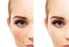 Short answer it is impossible to get rid of hyperpigmentation overnight. 10 Working Home Remedies For Skin Pigmentation