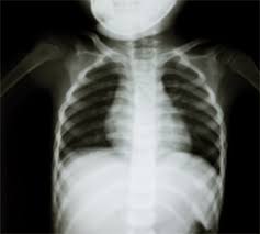 Image result for Chest Trauma