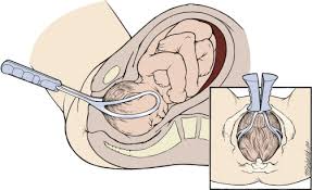 Image result for Forceps Assisted Delivery