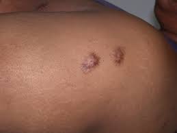 Image result for Neurotic Excoriation