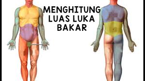 Api, uap panas, benda panas. Menghitung Luas Luka Bakar Youtube