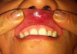 Image result for syphilis ulcer