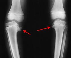 Infantile Blount S Disease Tibia Vara Pediatrics Orthobullets