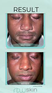 Rtw Skin Tunbridge Wells Zita