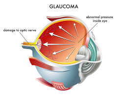 Glaucoma Fergus Falls Dry Eye Breckenridge Ocular