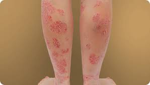 Image result for psoriasis