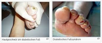 Diabetisches Fusssyndrom Die Pflegeexperten