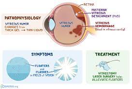 The bubble pushes the retina into place so it can heal properly. Vitreous Degeneration What Is It Causes Severity Treatment And More Osmosis