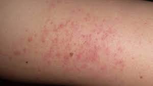 Raised Skin Bumps Pictures Types Causes And Treatment