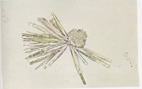 Les cristaux d'oxalate de calcium dans l'urine sont le constituant le plus courant des calculs rénaux humains , et la formation microscopie d'urine montrant plusieurs cristaux monohydratés d'oxalate de calcium (en forme d'haltère, certains d'entre eux agglutinés) et un cristal d' oxalate de calcium. Cristaux Urinaires Massart Sante Materiel Medical Et De Laboratoire
