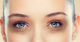 How To Hide A Hangover Conceal Your Dark Circles Followmeesh Png Dark Circles Under Eyes Eye Surgery Dark Circles