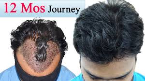 Best Hair Transplant In India Results Medispa India Dr Suneet Soni Jaipur Best Hair Transplant Hair Transplant In India Hair Transplant Results
