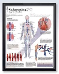 Understanding Dvt Chart 22x28 Nurse Nancy Cardiovascular