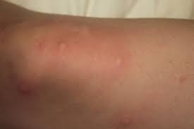 In the case of scabies, prescription medication is typically required to kill the mites. Sam Templeman On Twitter Dust Mite Allergy Dust Mites Bites Dust Mites